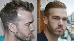 Understanding Receding Hairline Hair Transplant: A Comprehensive Guide