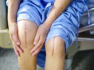 Knee Replacement Market Growth is projected to driven by Rising Geriatric Population