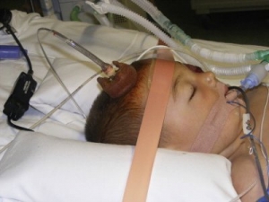 The Global Intracranial Pressure Monitoring Devices Market is driven by technological advancements