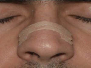 Internal Nasal Dilators Market Driven By Growing Occurrence of Nasal Respiratory Disorders