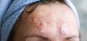 Blepharitis Treatment Market is driven by increasing awareness of blepharitis condition