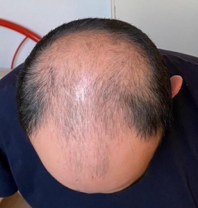 Dubai's Legacy of Excellence in Personalized Hair Transplant