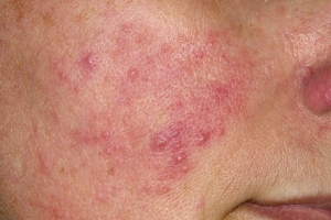 Rosacea Demystified: Understanding Triggers and Treatment