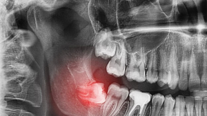 : Fashionable and Functional: The Evolution of Mouthguard Designs