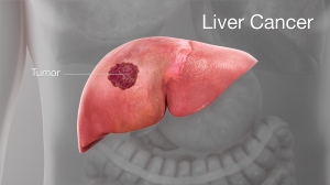 What causes liver cancer