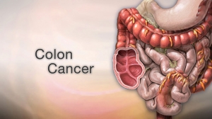 Introduction to Colon cancer and its Potential side effects Myths and Facts