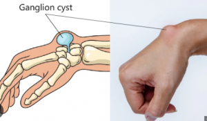 Understanding Ganglion Cysts: Causes, Symptoms, and Treatment