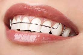Orthodontic Retention: The Crucial Phase in Achieving a Lasting Smile