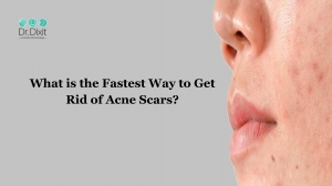 What is the Fastest Way to Get Rid of Acne Scars? 