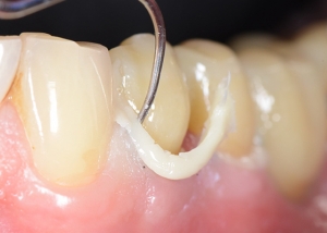 The Art and Science of Dental Bonding Aesthetics 