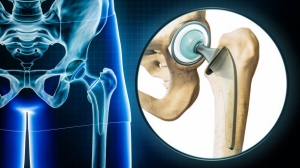 The Hip Replacement Market driven by increasing geriatric population worldwide
