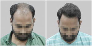 Unveiling Confidence: Satya Hair Transplant, Your Ultimate Destination for Hair Restoration in Delhi