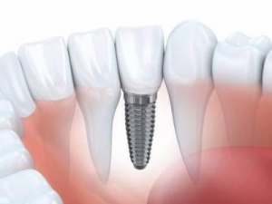 Dental Membrane and Bone Graft Substitute: The Future of Dental Implant Surgery