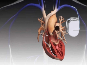 Cardiac Implants: The Future of Heart Healthcare 