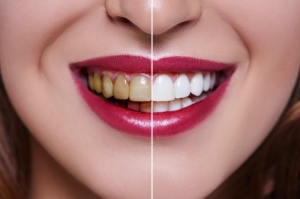 Sensitive Teeth? No Problem! The Gentle Approach to Whitening in Dubai