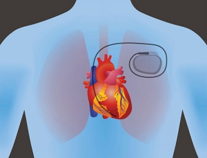 Evolving Electrotherapy: Trends and Growth in the Cardiac Pacemaker Industry