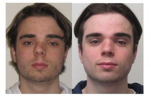 Enhance Your Look with Male Rhinoplasty in Dubai