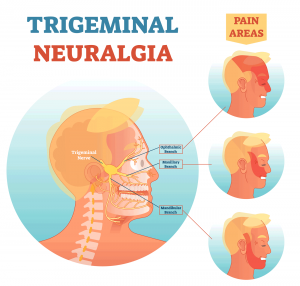 Exploring Homeopathic Remedies for Trigeminal Neuralgia: A Holistic Approach to Pain Management