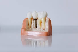 Overcoming Dental Anxiety: How Same Day Implants Offer Comfort and Convenience