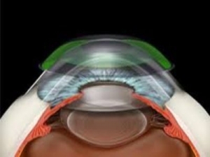 Exploring the Visionary Solution: Orthokeratology
