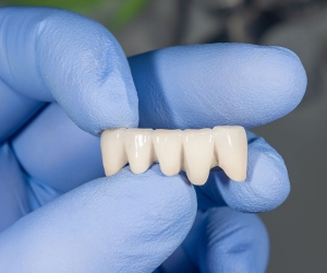 What Are Dental Crowns and Tooth Bridges?