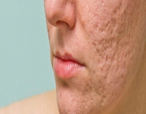 Achieving Smooth Skin: Effective Acne Scar Treatment in Delhi