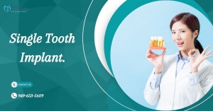 Transform Your Smile: Single Tooth Implant Services in Tustin, CA - Restore Confidence with Expert Dental Care!