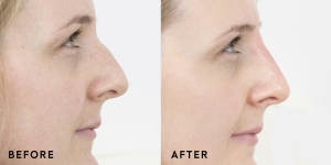 Non-Surgical Nose Job: Enhancing Confidence Naturally