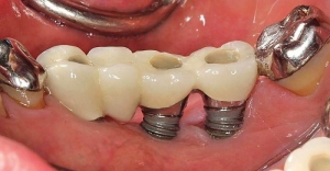 Case Studies: Successful Management of Dental Implant Infections