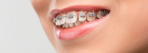 Braces in Dubai - How Do You Choose the Right Type of Braces?