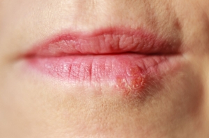 How to Heal Herpes Sores Faster?