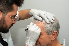 Hair Transplant Excellence in Dubai: Enhancing Natural Beauty