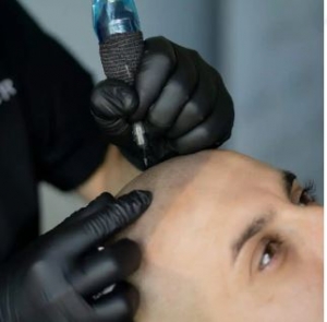 Revolutionizing Hair Restoration: The Growth of Vancouver Hair Transplant Clinics