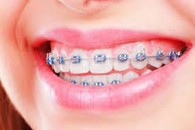 Metal Braces for Adults: It's Never Too Late to Straighten Your Teeth
