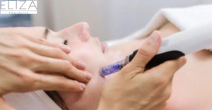 Microneedling Southampton: What to Expect