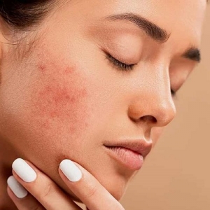 Diet and Acne: Myths and Facts Unveiled