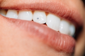 The Ultimate Bling: Diamond Teeth Shine in Dubai