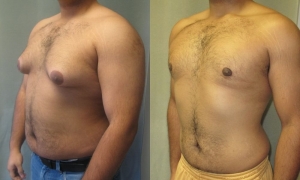 Male Breast Reduction Surgery