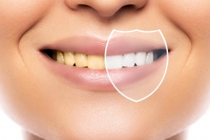 Unveiling a Dazzling Smile: Insights into the Number of Zoom Teeth Whitening Sessions