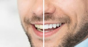 Radiant Results: How Zoom Teeth Whitening Delivers a Whiter, Brighter Smile