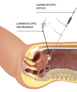 Precision in Practice: Mumbai's Renowned Laparoscopy Surgeon Sets the Standard!