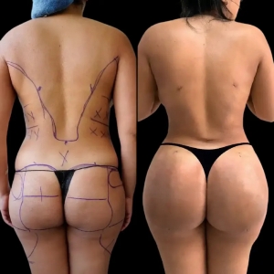 Tailoring Brazilian Butt Lifts to Your Body Type in Dubai