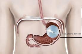 Gastric Balloon: Is Dubai the Right Fit for You?