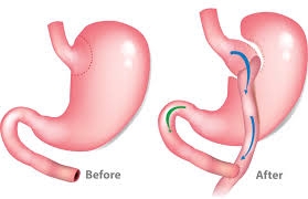 Post-Operative Care: Navigating Recovery After Bariatric Surgery in Dubai