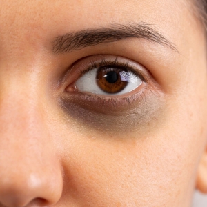 Dubai's Unique Solutions for Banishing Dark Circles