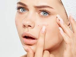 The Ultimate Guide to Effective Acne Treatment Methods