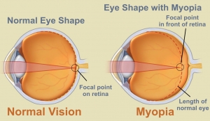 Managing Myopia and  Strategies for Navigating the Growing Epidemic