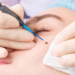 Reclaim Your Skin: Wart Removal Options in Dubai