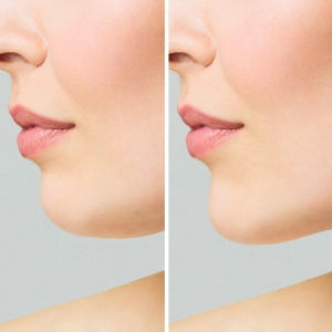 Chin Augmentation Before and After Care Tips