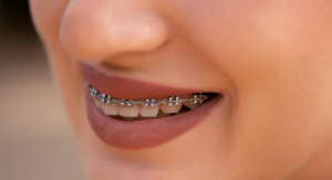 Achieving a Radiant Smile with Arlington Braces